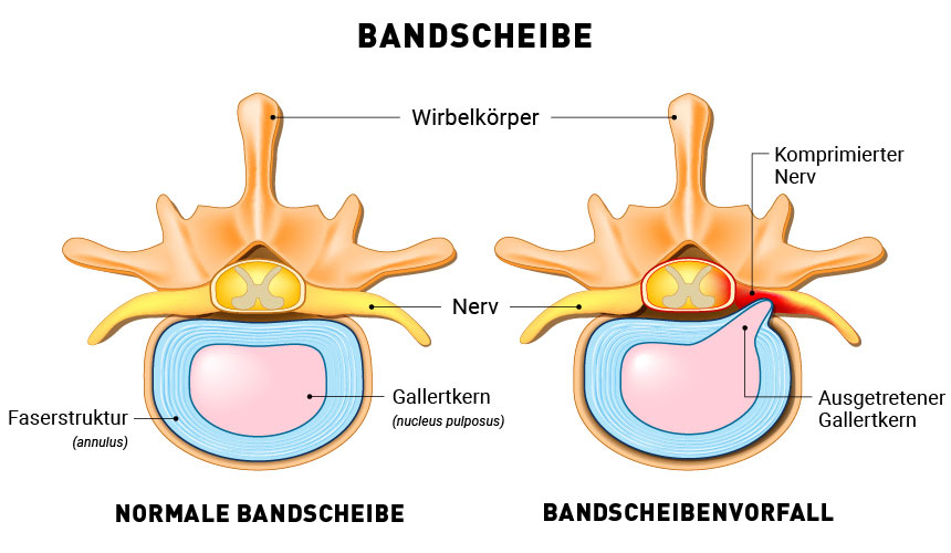 Schematische Darstellung eines Bandscheibenvorfalls